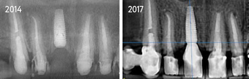Implant Xrays_2
