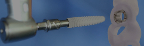 implant-surgery-overlay